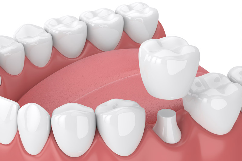 Dental Crowns in Warner Robins