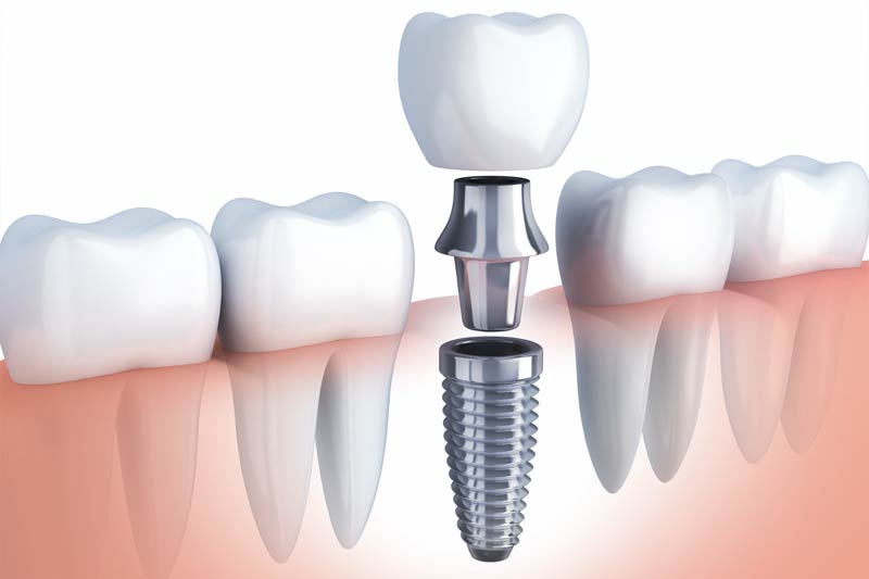 Implants Dentist in Warner Robins