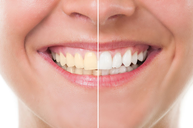 Teeth Whitening in Warner Robins