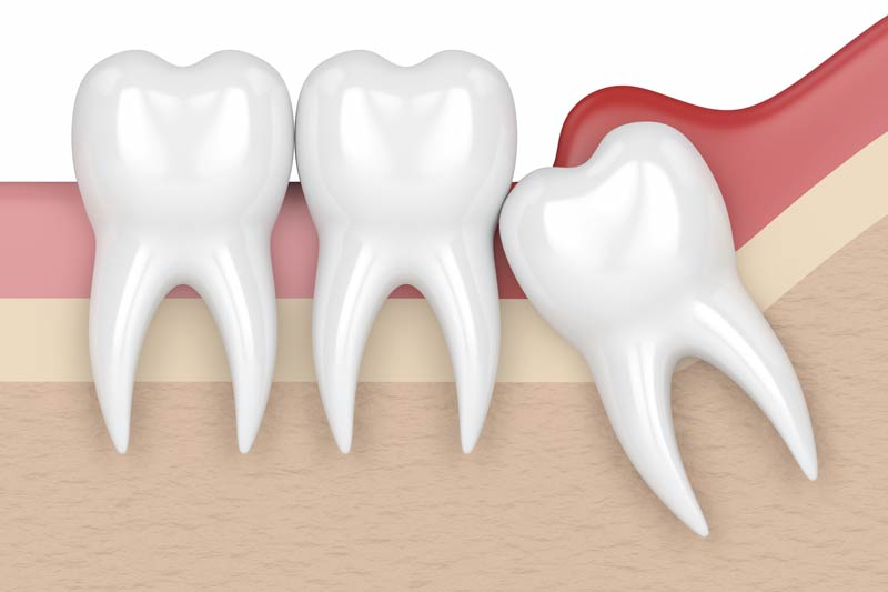 Wisdom Tooth Removal in Warner Robins